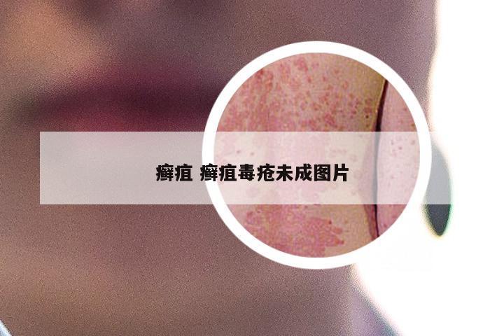 癣疽 癣疽毒疮未成图片