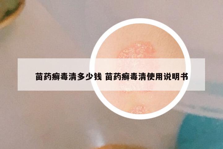 苗药癣毒清多少钱 苗药癣毒清使用说明书