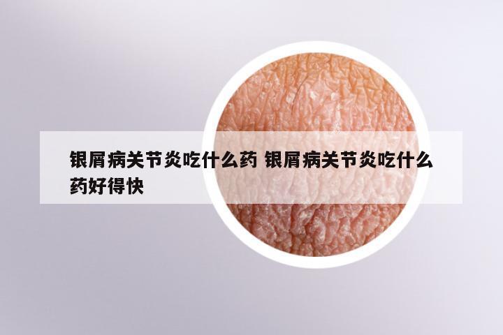 银屑病关节炎吃什么药 银屑病关节炎吃什么药好得快