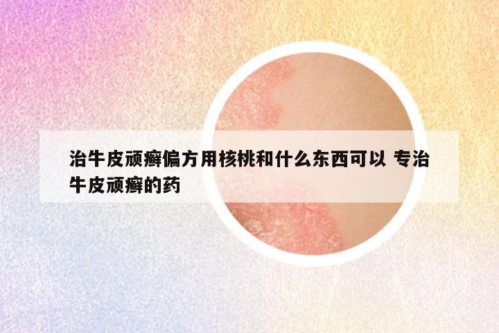 治牛皮顽癣偏方用核桃和什么东西可以 专治牛皮顽癣的药