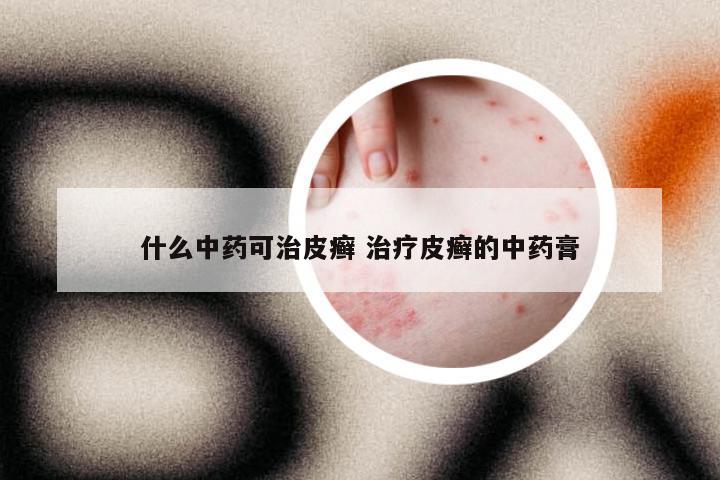 什么中药可治皮癣 治疗皮癣的中药膏