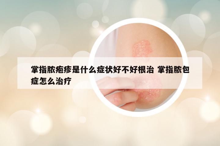 掌指脓疱疹是什么症状好不好根治 掌指脓包症怎么治疗