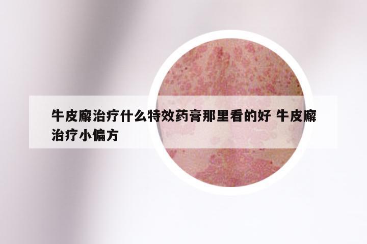 牛皮廨治疗什么特效药膏那里看的好 牛皮廨治疗小偏方