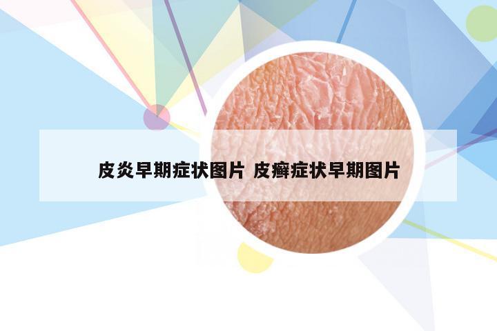 皮炎早期症状图片 皮癣症状早期图片
