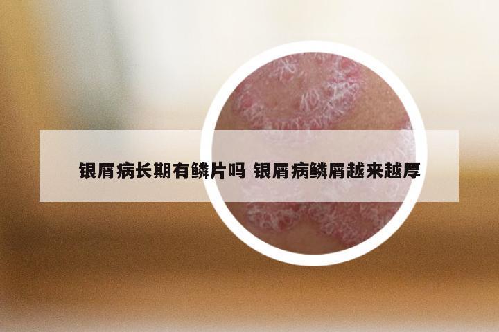 银屑病长期有鳞片吗 银屑病鳞屑越来越厚