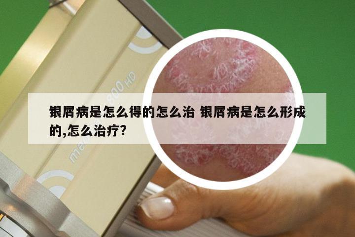 银屑病是怎么得的怎么治 银屑病是怎么形成的,怎么治疗?