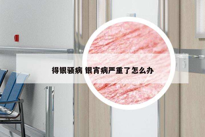 得银骚病 银宵病严重了怎么办