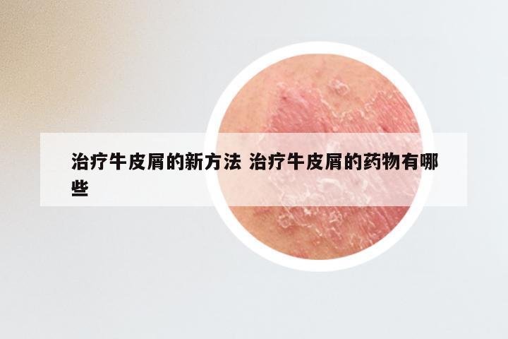 治疗牛皮屑的新方法 治疗牛皮屑的药物有哪些