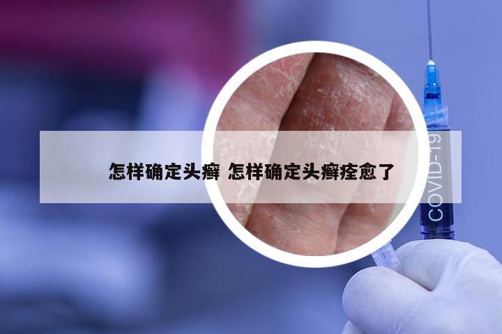 怎样确定头癣 怎样确定头癣痊愈了