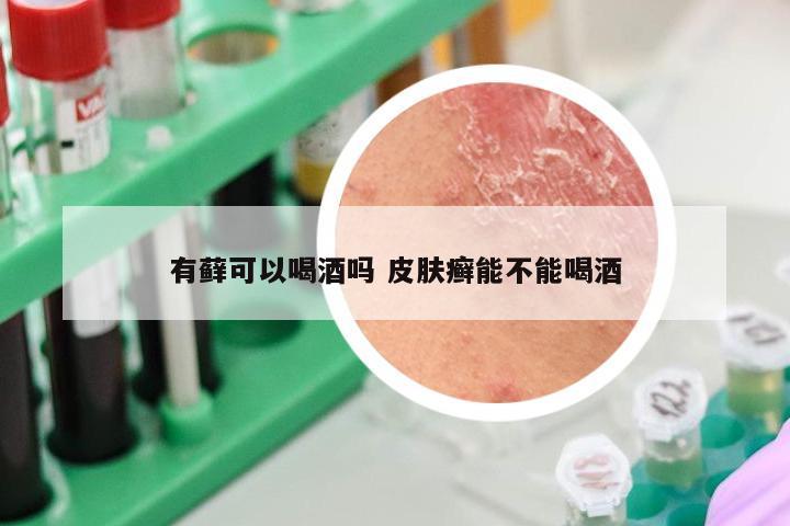 有藓可以喝酒吗 皮肤癣能不能喝酒