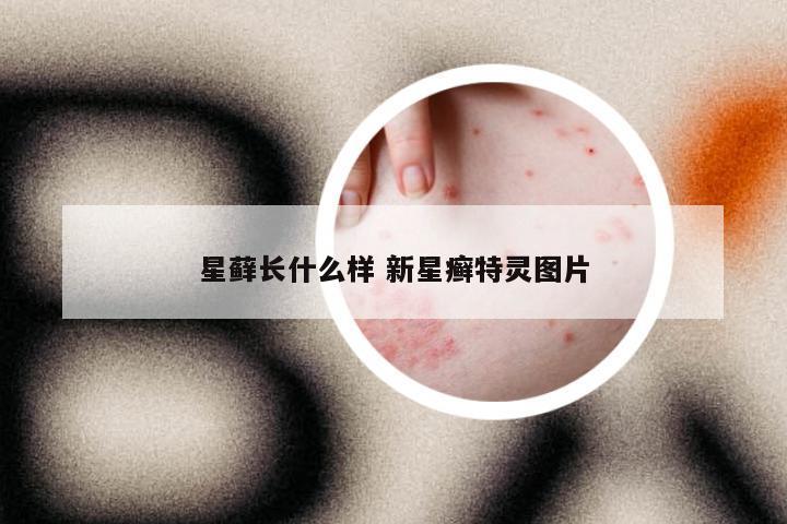 星藓长什么样 新星癣特灵图片