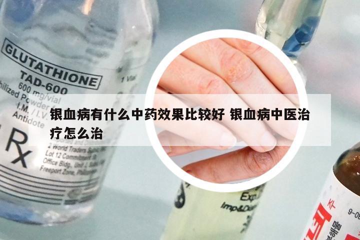 银血病有什么中药效果比较好 银血病中医治疗怎么治