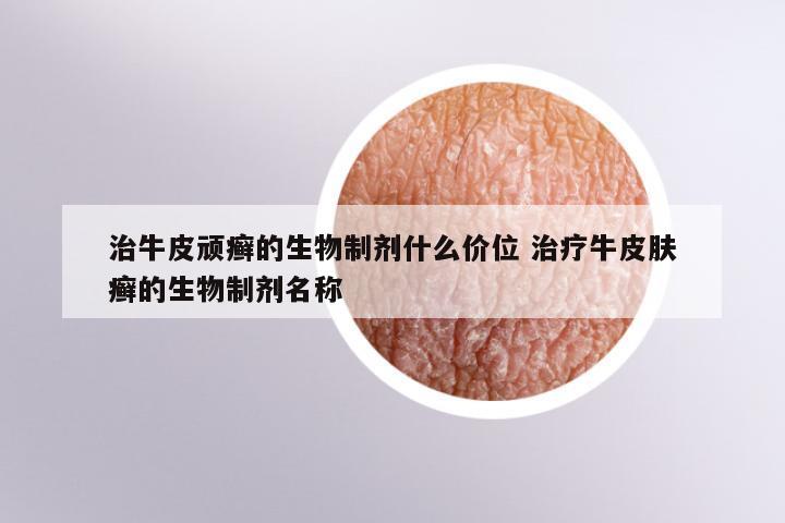 治牛皮顽癣的生物制剂什么价位 治疗牛皮肤癣的生物制剂名称