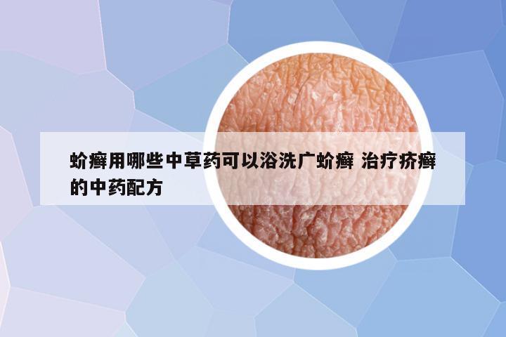 蚧癣用哪些中草药可以浴洗广蚧癣 治疗疥癣的中药配方