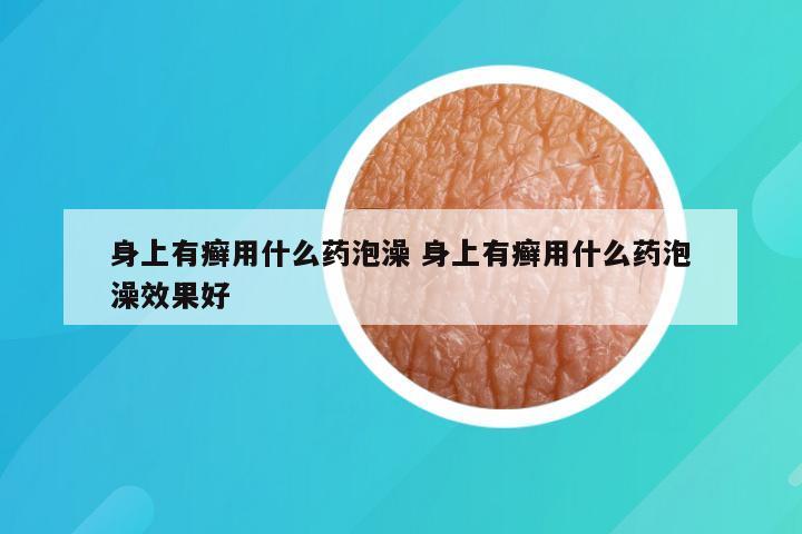 身上有癣用什么药泡澡 身上有癣用什么药泡澡效果好