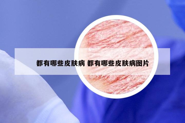 都有哪些皮肤病 都有哪些皮肤病图片