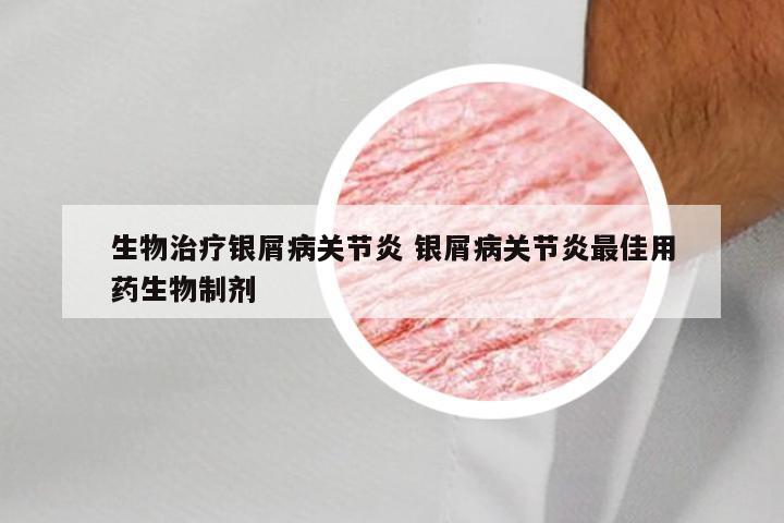 生物治疗银屑病关节炎 银屑病关节炎最佳用药生物制剂