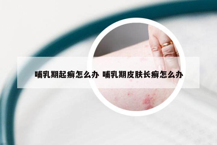 哺乳期起癣怎么办 哺乳期皮肤长癣怎么办