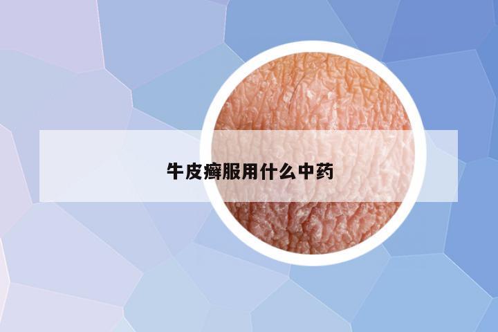 牛皮癣服用什么中药