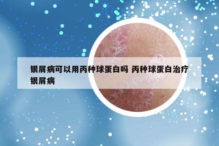 银屑病可以用丙种球蛋白吗 丙种球蛋白治疗银屑病