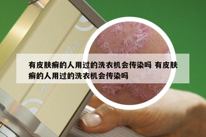 有皮肤癣的人用过的洗衣机会传染吗 有皮肤癣的人用过的洗衣机会传染吗
