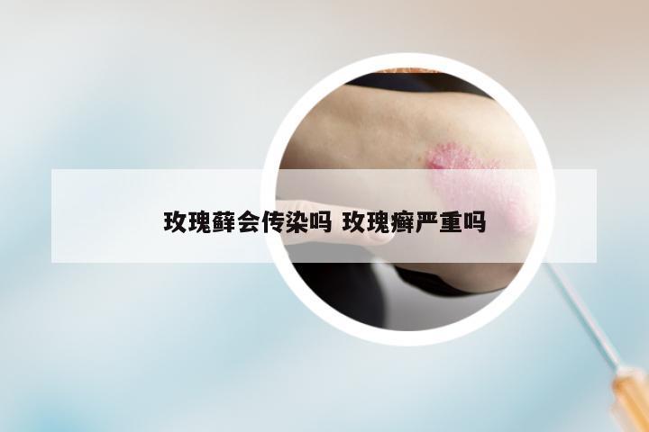 玫瑰藓会传染吗 玫瑰癣严重吗