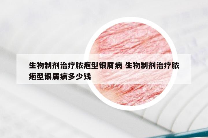 生物制剂治疗脓疱型银屑病 生物制剂治疗脓疱型银屑病多少钱