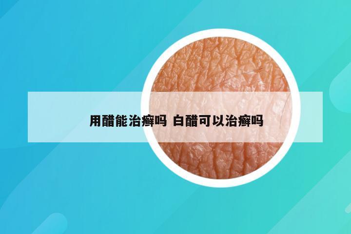用醋能治癣吗 白醋可以治癣吗