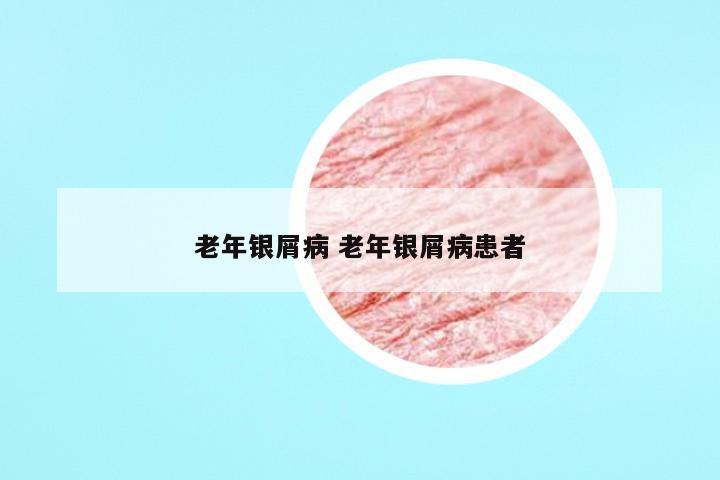 老年银屑病 老年银屑病患者