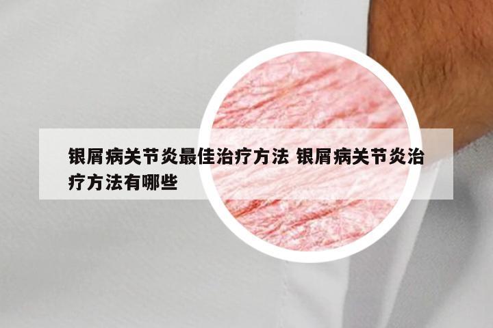 银屑病关节炎最佳治疗方法 银屑病关节炎治疗方法有哪些
