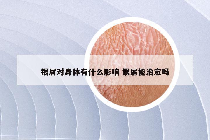 银屑对身体有什么影响 银屑能治愈吗