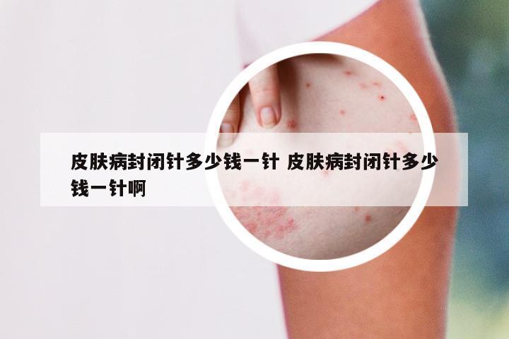 皮肤病封闭针多少钱一针 皮肤病封闭针多少钱一针啊