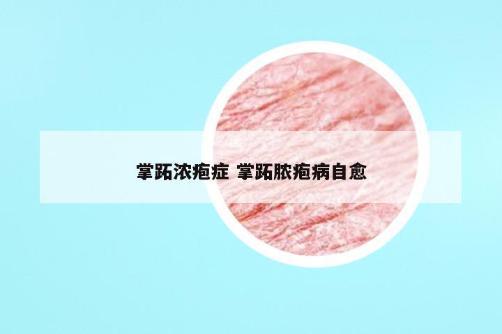 掌跖浓疱症 掌跖脓疱病自愈