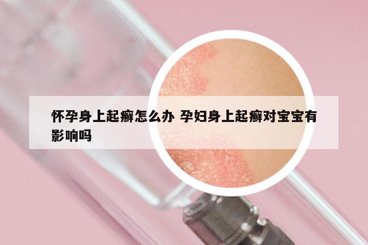 怀孕身上起癣怎么办 孕妇身上起癣对宝宝有影响吗