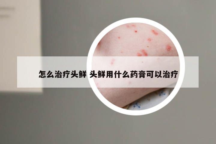 怎么治疗头鲜 头鲜用什么药膏可以治疗