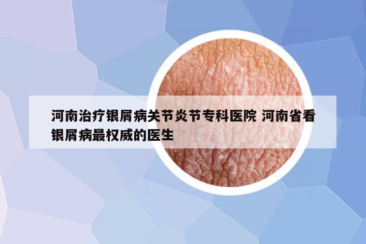 河南治疗银屑病关节炎节专科医院 河南省看银屑病最权威的医生