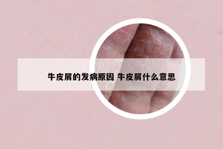 牛皮屑的发病原因 牛皮屑什么意思