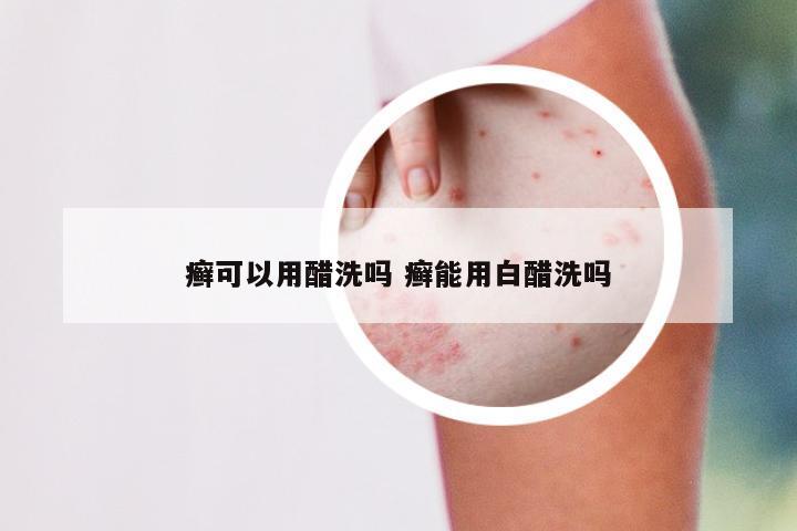 癣可以用醋洗吗 癣能用白醋洗吗