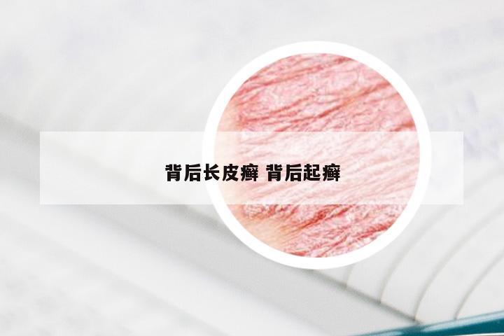 背后长皮癣 背后起癣