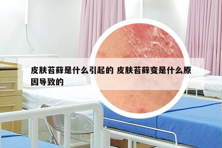 皮肤苔藓是什么引起的 皮肤苔藓变是什么原因导致的