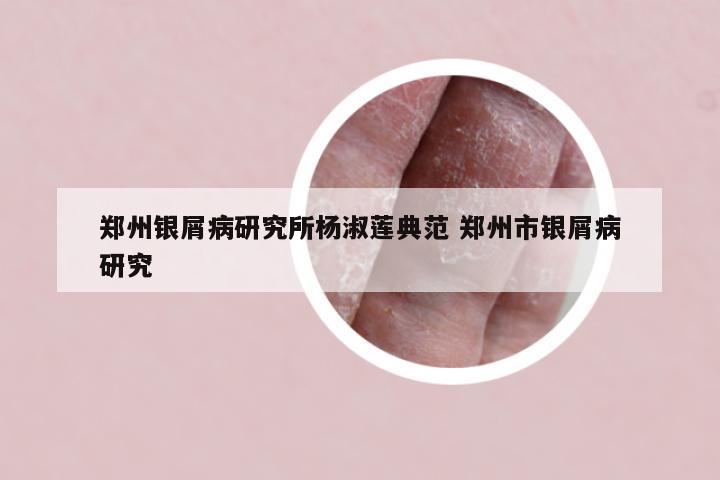 郑州银屑病研究所杨淑莲典范 郑州市银屑病研究