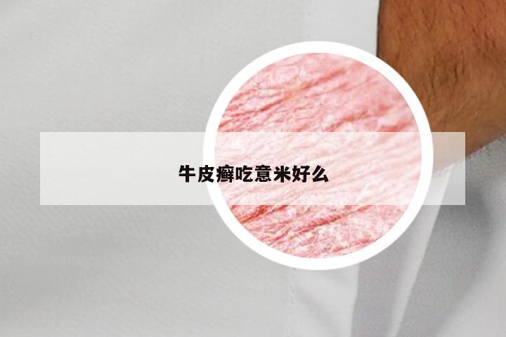 牛皮癣吃意米好么