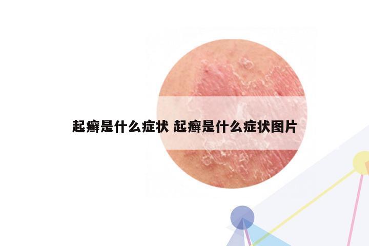 起癣是什么症状 起癣是什么症状图片