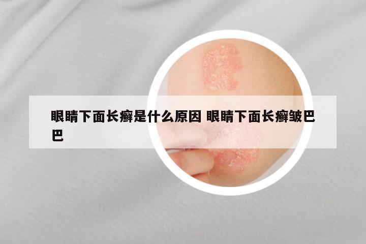 眼睛下面长癣是什么原因 眼睛下面长癣皱巴巴