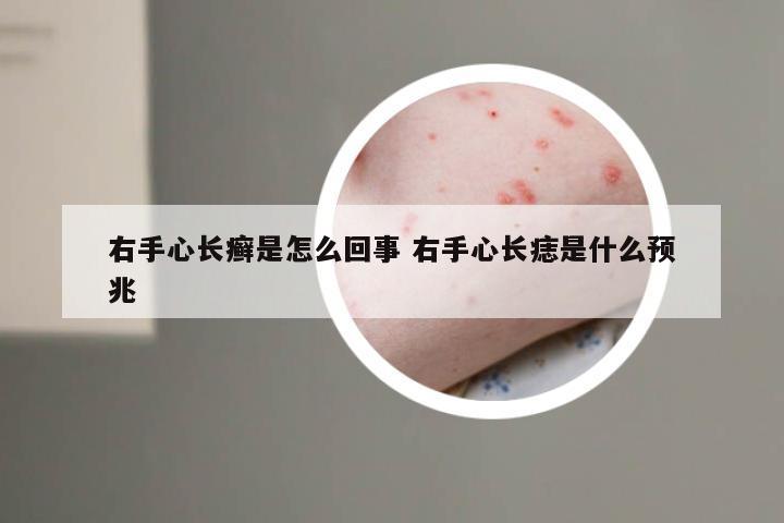 右手心长癣是怎么回事 右手心长痣是什么预兆