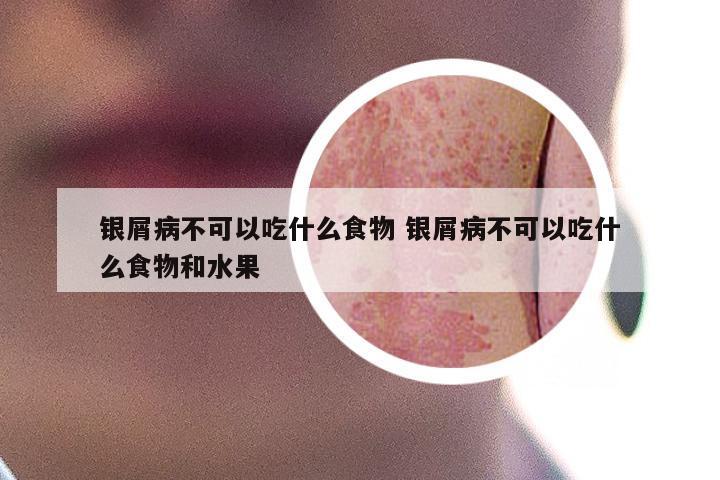 银屑病不可以吃什么食物 银屑病不可以吃什么食物和水果