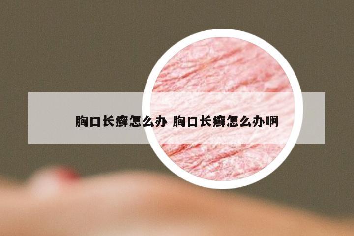 胸口长癣怎么办 胸口长癣怎么办啊