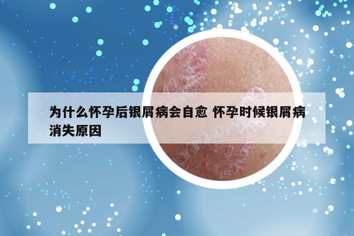 为什么怀孕后银屑病会自愈 怀孕时候银屑病消失原因