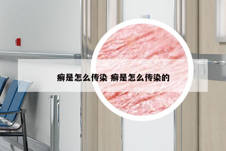 癣是怎么传染 癣是怎么传染的