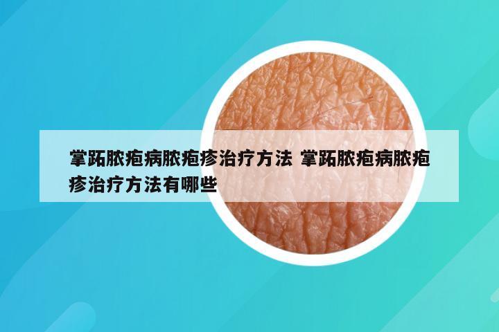 掌跖脓疱病脓疱疹治疗方法 掌跖脓疱病脓疱疹治疗方法有哪些